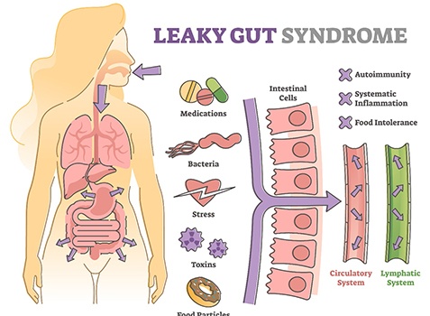 Illustration showing how leaky gut syndrome works