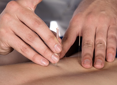 Physician placing medical acupuncture needles