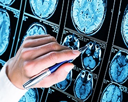 Scan of brain of epilespy patient
