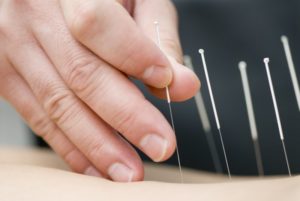 Hand carefully inserting needles for medical acupuncture into patient’s skin