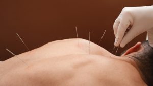 Gloved hand inserting medical acupuncture needles into patient’s back