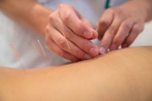 Hands inserting medical acupuncture needles into patient’s back