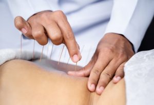 Doctor carefully inserting acupuncture needles into patient