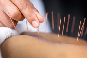 Close-up of hand inserting acupuncture needle into patient’s skin